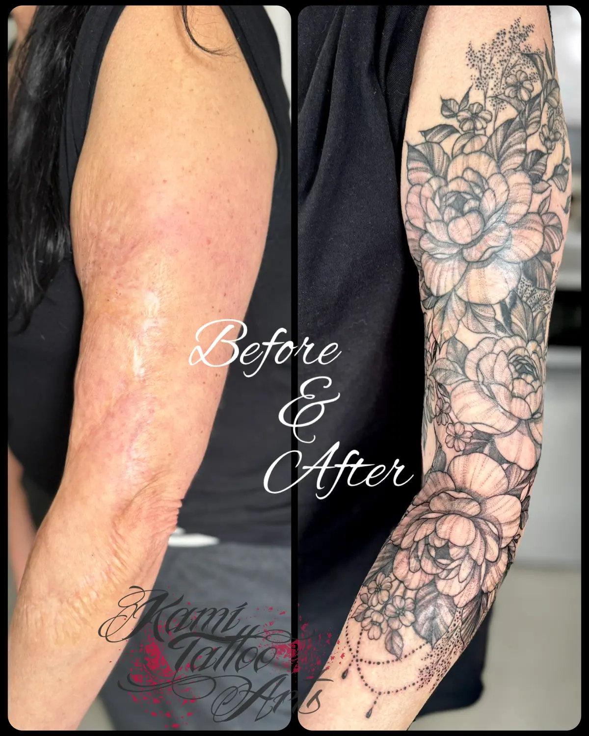Scars Cover Up Tattoo Peony Flowers Linework Fineline